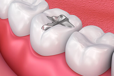 The image is a digital rendering of an open human mouth with a focus on the upper front teeth. There s a visible dental implant post protruding from the gum, indicating a missing tooth that has been prepared for dental implant placement.