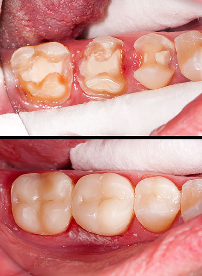 Before and after dental treatment comparison, showing a patient s teeth with severe decay and discoloration before treatment and the same mouth after cleaning and restoration.