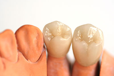 An image of two rows of teeth, one with a natural tooth appearance and the other with an artificial tooth appearance, displayed side by side.