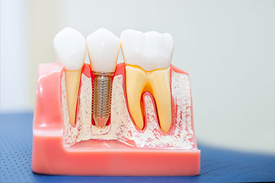 The image displays a dental model with artificial teeth, some of which are missing, and an implant screwed into the jaw.