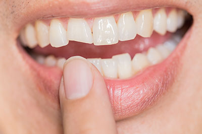 The image shows a close-up of a person s teeth with a focus on the lower front tooth, which appears to be chipped or damaged. The individual is holding their finger near their mouth, possibly in an attempt to examine or fix the issue.
