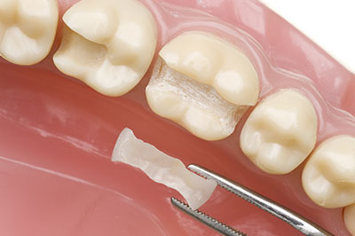 A dental implant with a screw, set against the backdrop of a tooth with a missing crown.