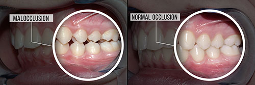 The image shows a side-by-side comparison of two sets of teeth with a magnified view of the lower teeth, highlighting the differences between normal and malocclusion.