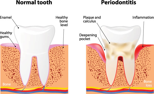 The image displays a medical illustration of a tooth with a caption explaining the normal and diseased states, specifically related to periodontitis.