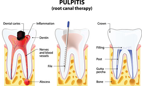 The image is a medical illustration showing the internal structure of a tooth with labels pointing out different parts, such as the pulpit, root canal therapy, crown, dental caries, inflammation, and fillings.