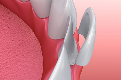 The image shows a close-up view of a dental implant with a screw visible, inserted into a pink gum tissue background.