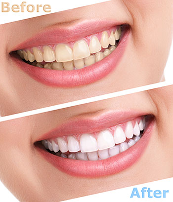 The image shows a before and after comparison of a person s teeth, with the  before  showing stained teeth and the  after  showing bright white teeth, suggesting a dental whitening treatment.