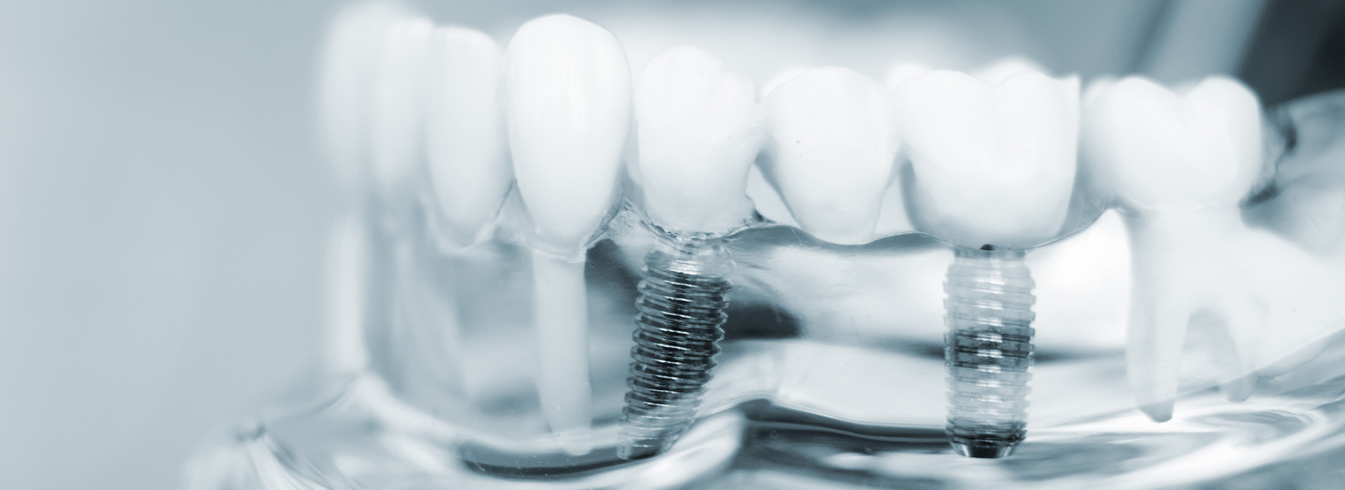 The image depicts a close-up of multiple dental implants with visible screws, arranged in a row against a white background.